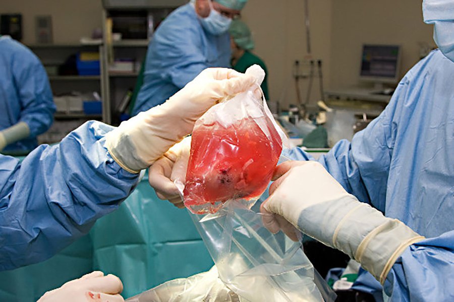 Nierentransplantationen ersparen den Betroffenen mehrere langwierige Dialysesitzungen pro Woche. Foto: horizong 21/Fotolia